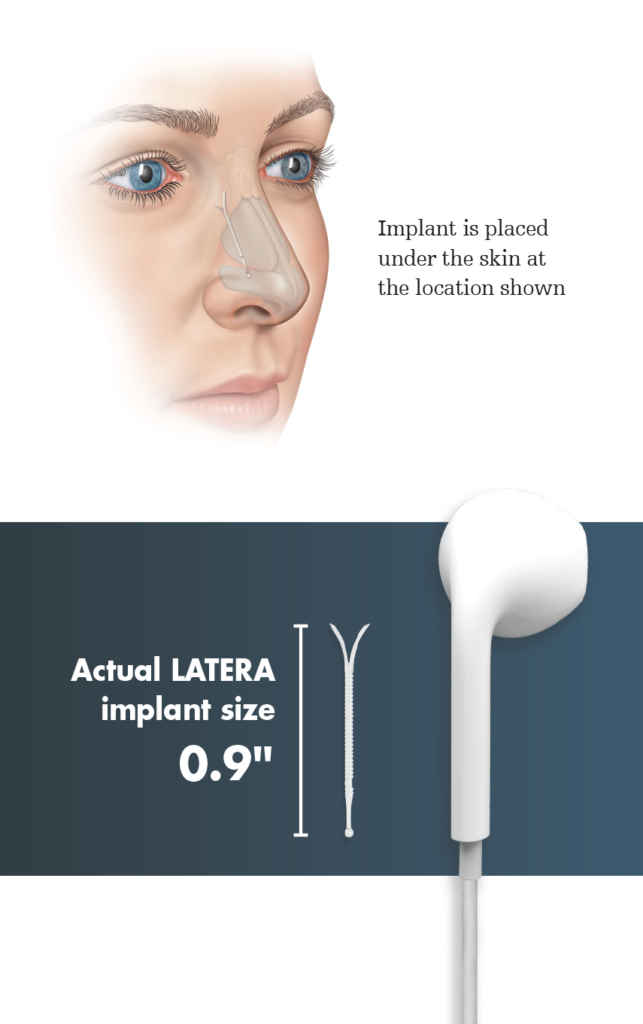 Latera implant