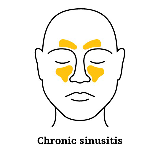 chronic sinusitis illustration
